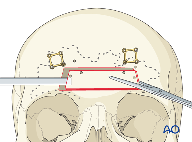 Access osteotomy – Subcranial access osteotomy