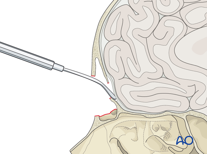 Access osteotomy – Subcranial access osteotomy