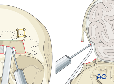 Access osteotomy – Subcranial access osteotomy