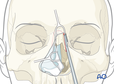 Access osteotomy - Lateral Rhinotomy