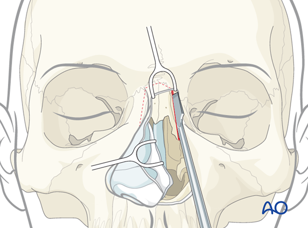 Access osteotomy - Lateral Rhinotomy