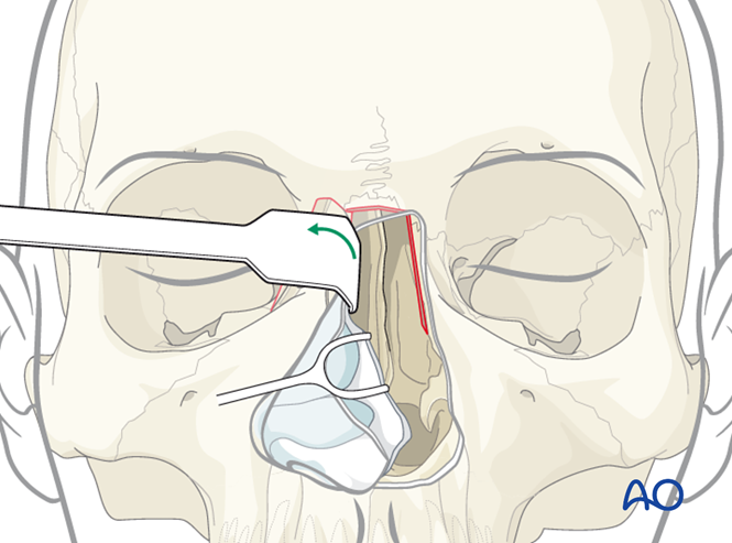 Pericranial Flap For Anterior Skull Base Without Orbital Involvement