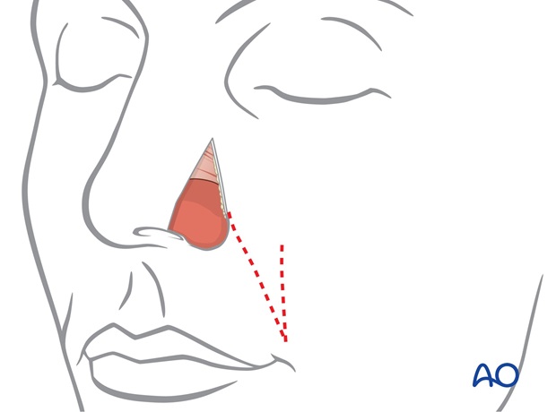 Nose Reconstruction by Dr. Frederick J Menick