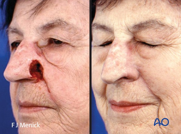 Nose Reconstruction by Dr. Frederick J Menick