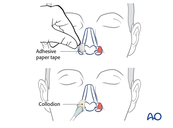 Two stage forehead flap - Ala reconstruction for Large partial ...