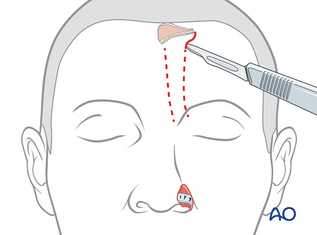 two stage forehead flap ala reconstruction
