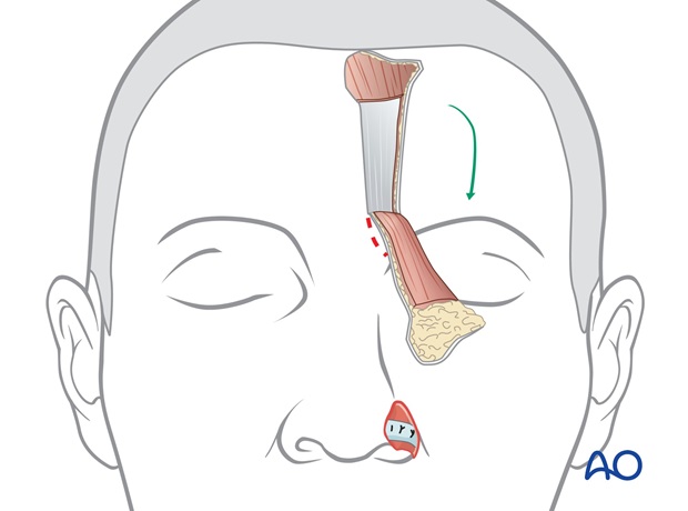 two stage forehead flap ala reconstruction