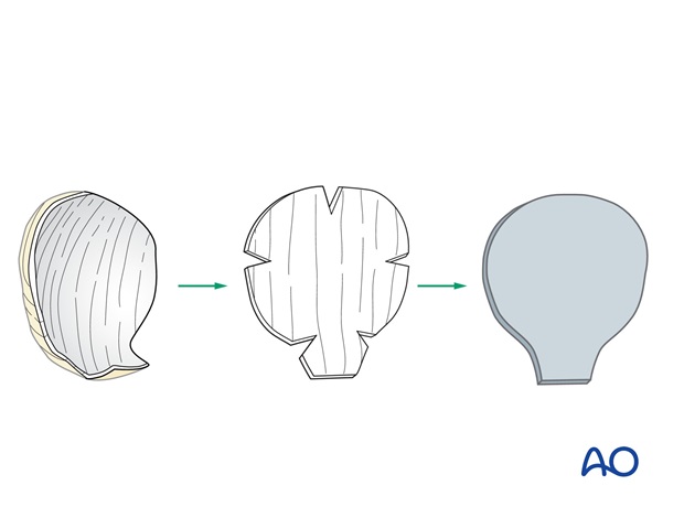 Nose Reconstruction by Dr. Frederick J Menick