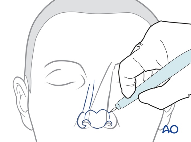 two stage forehead flap tip reconstruction