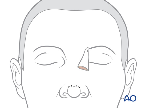 Nose Reconstruction by Dr. Frederick J Menick