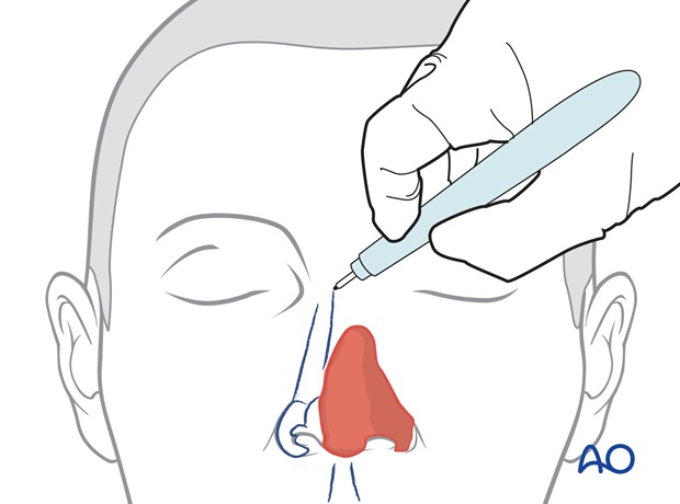 Nose Reconstruction by Dr. Frederick J Menick