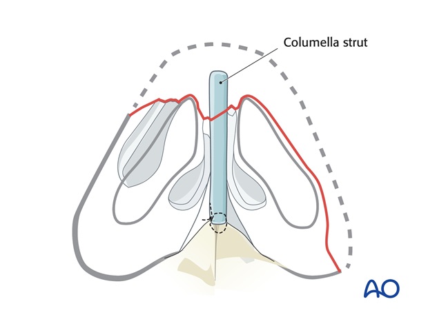 Nose Reconstruction by Dr. Frederick J Menick