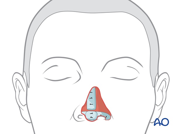 Nose Reconstruction by Dr. Frederick J Menick