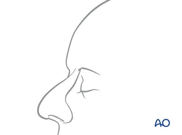 Nose Reconstruction by Dr. Frederick J Menick