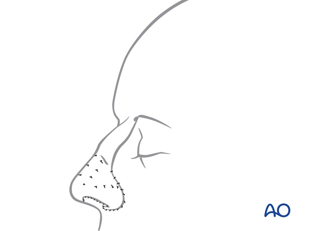 Nose Reconstruction by Dr. Frederick J Menick