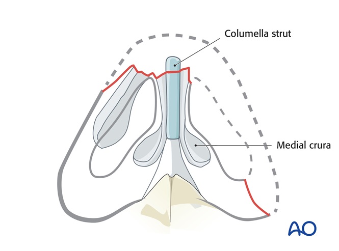 Three stage forehead folded flap for Full thickness defects
