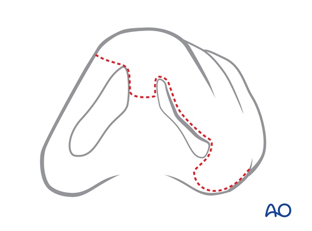 Nose Reconstruction by Dr. Frederick J Menick