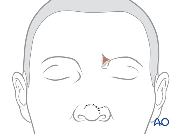 Nose Reconstruction by Dr. Frederick J Menick