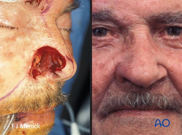 Nose Reconstruction by Dr. Frederick J Menick