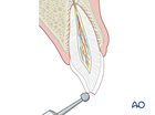 tooth fracture enamel dentin