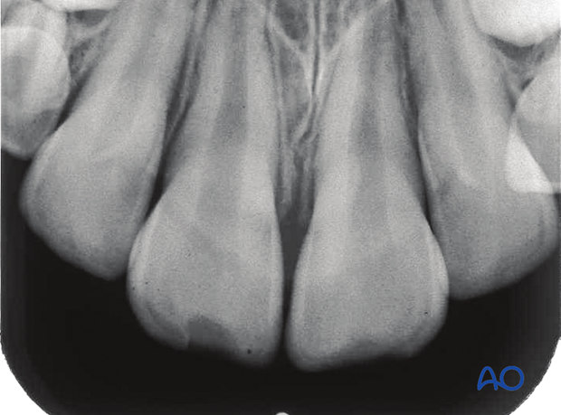 Enamel fractures in the two central incisors with limited loss of substance