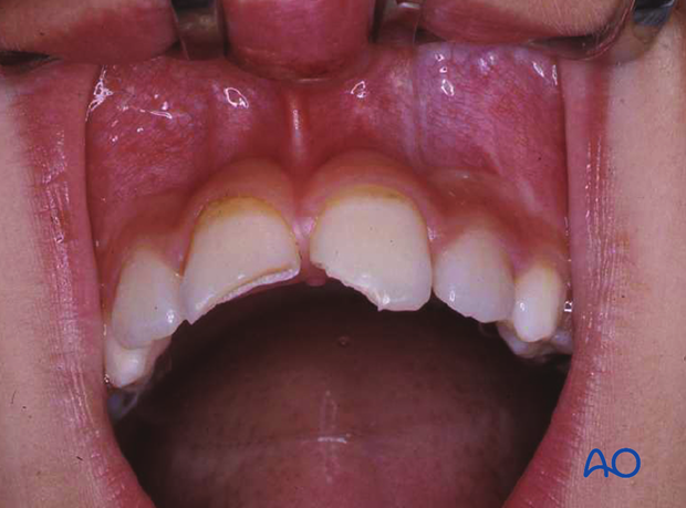 Fracture of two incisors with loss of major crown fragments