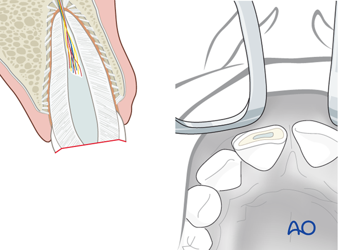 Pulp capping / partial amputation / extirpation for Tooth fracture ...