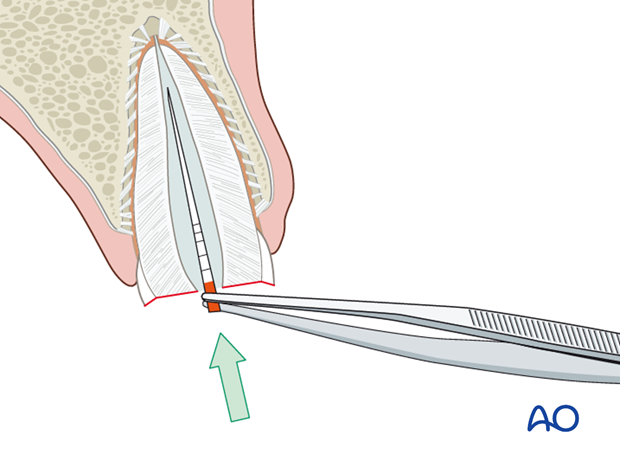 Placement of desinfectant and sealing of root canal