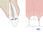 tooth fracture pulp exposure