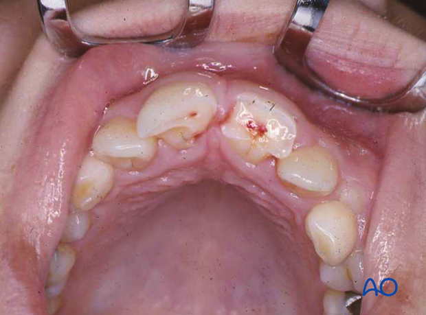 Incisor with enamel-dentin-pulp fracture