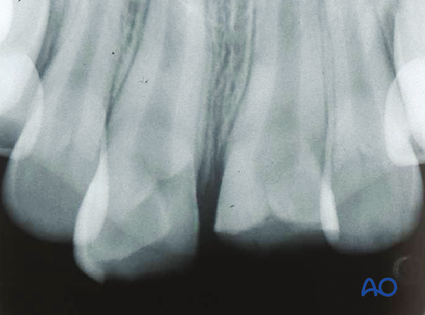 Complicated crown fractures of maxillary central incisors