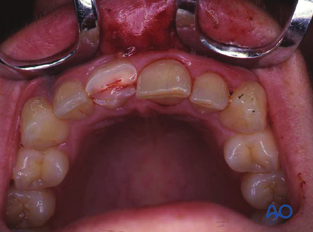 The axial view shows the orientation of the fracture taking a mesiodistal course