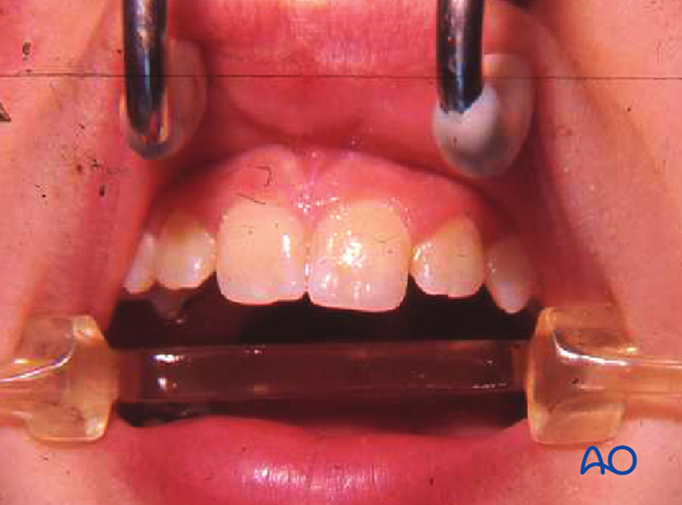 Lateral incisors have not yet reached their final position