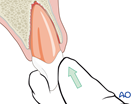 tooth luxation with displacement extrusion
