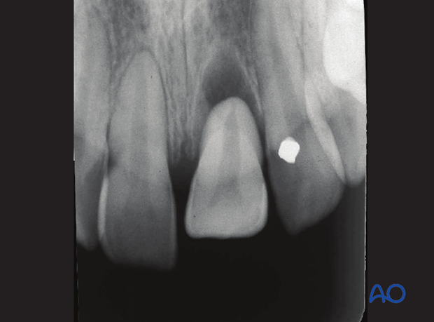 Axially dislocated tooth out of its socket with partial loss of bony attachment