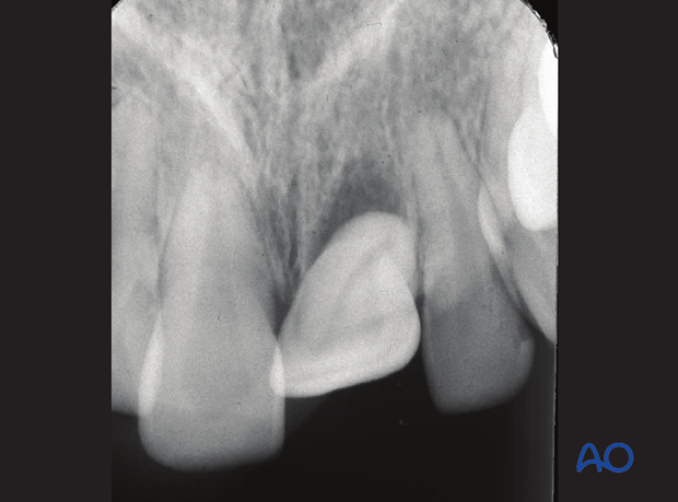 Axially dislocated tooth out of its socket with partial loss of bony attachment