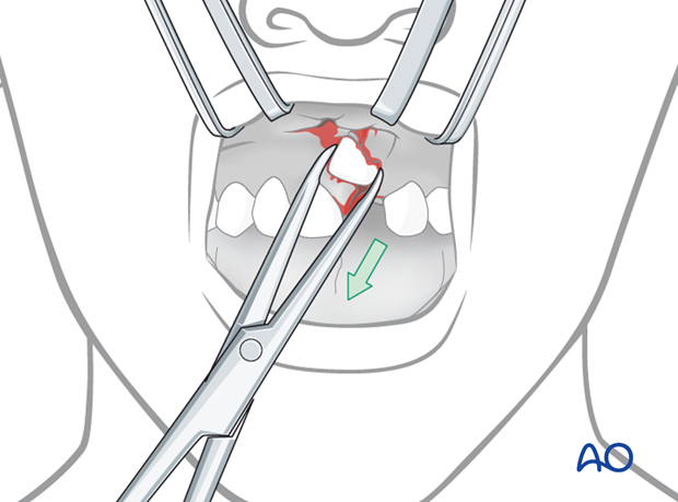 The tooth is pulled by the forceps