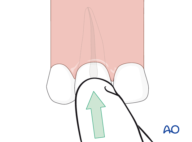 Replanted tooth prior to the arriving at the dentist