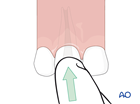 tooth luxation avulsion total luxation