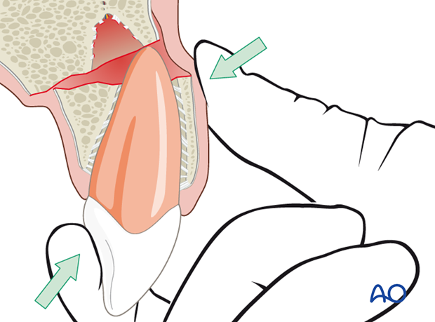 Repositioning of the tooth-bearing alveolus