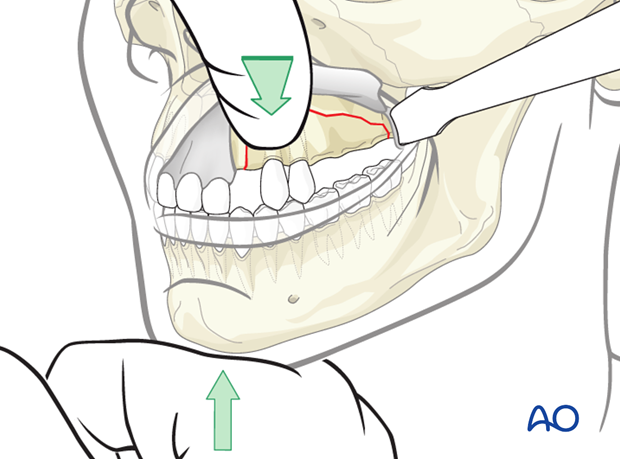 Repositioning of the fractured segment