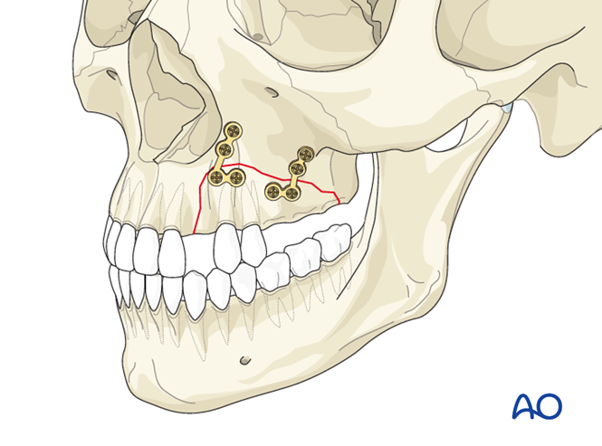 Open reduction internal fixation for Alveolar fracture, segmental