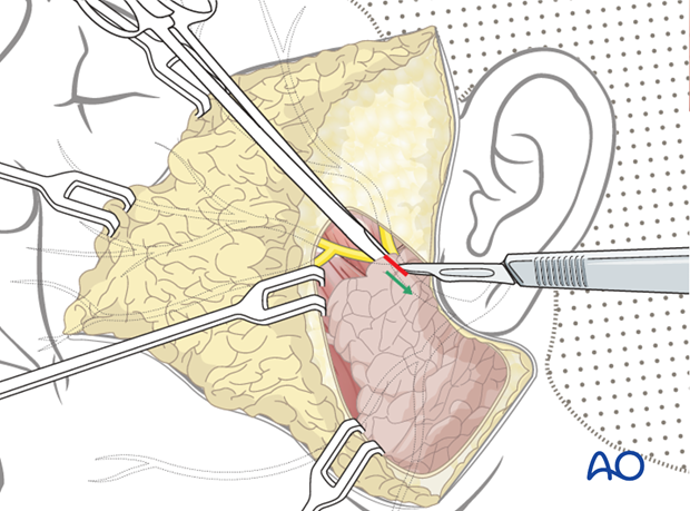 direct nerve repair