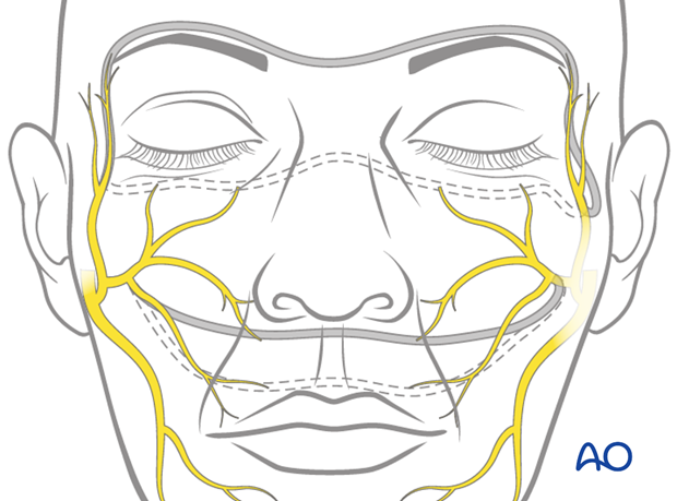 reinnervation with cross facial nerve graft