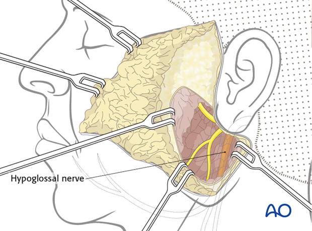 reinnervation with hypoglossal nerve
