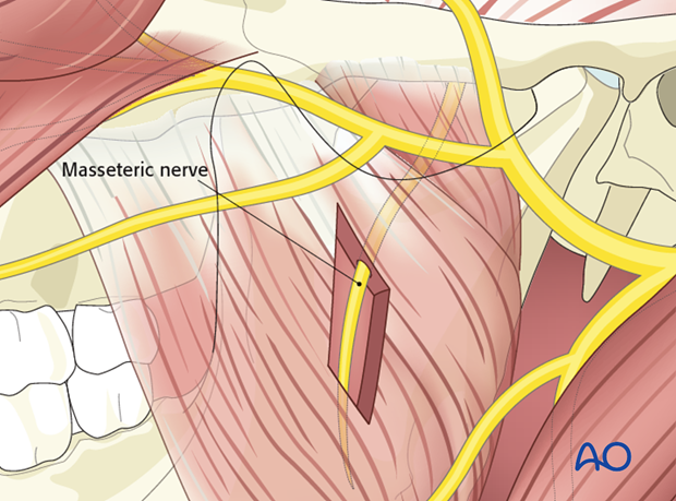 reinnervation with masseteric nerve transposition