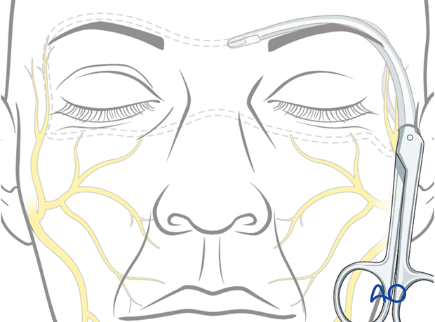 selective reinnervation with contralateral facial nerve and masseteric nerve