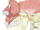 reversible paralysis