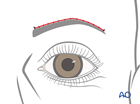 irreversible paralysis eye complex