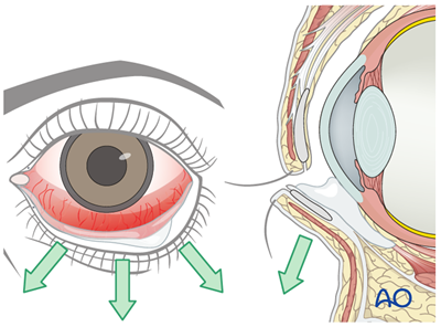 Lower eyelid - Lateral strip canthopexy for Irreversible paralysis, eye ...